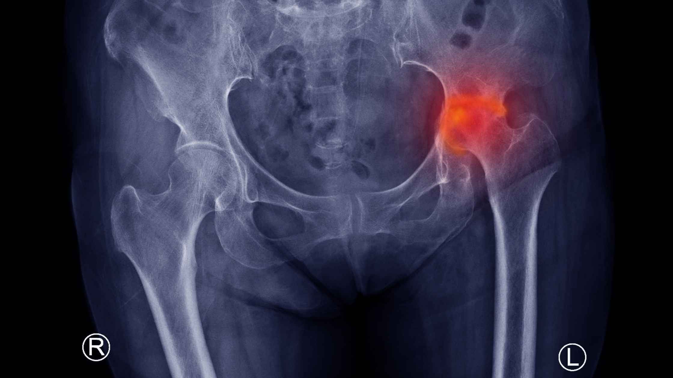 AVN of the Hip