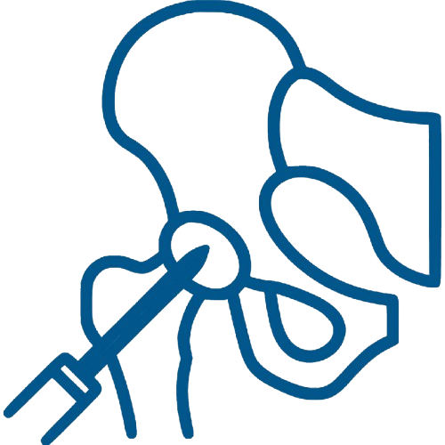 AVN (Avascular Necrosis) of the Hip