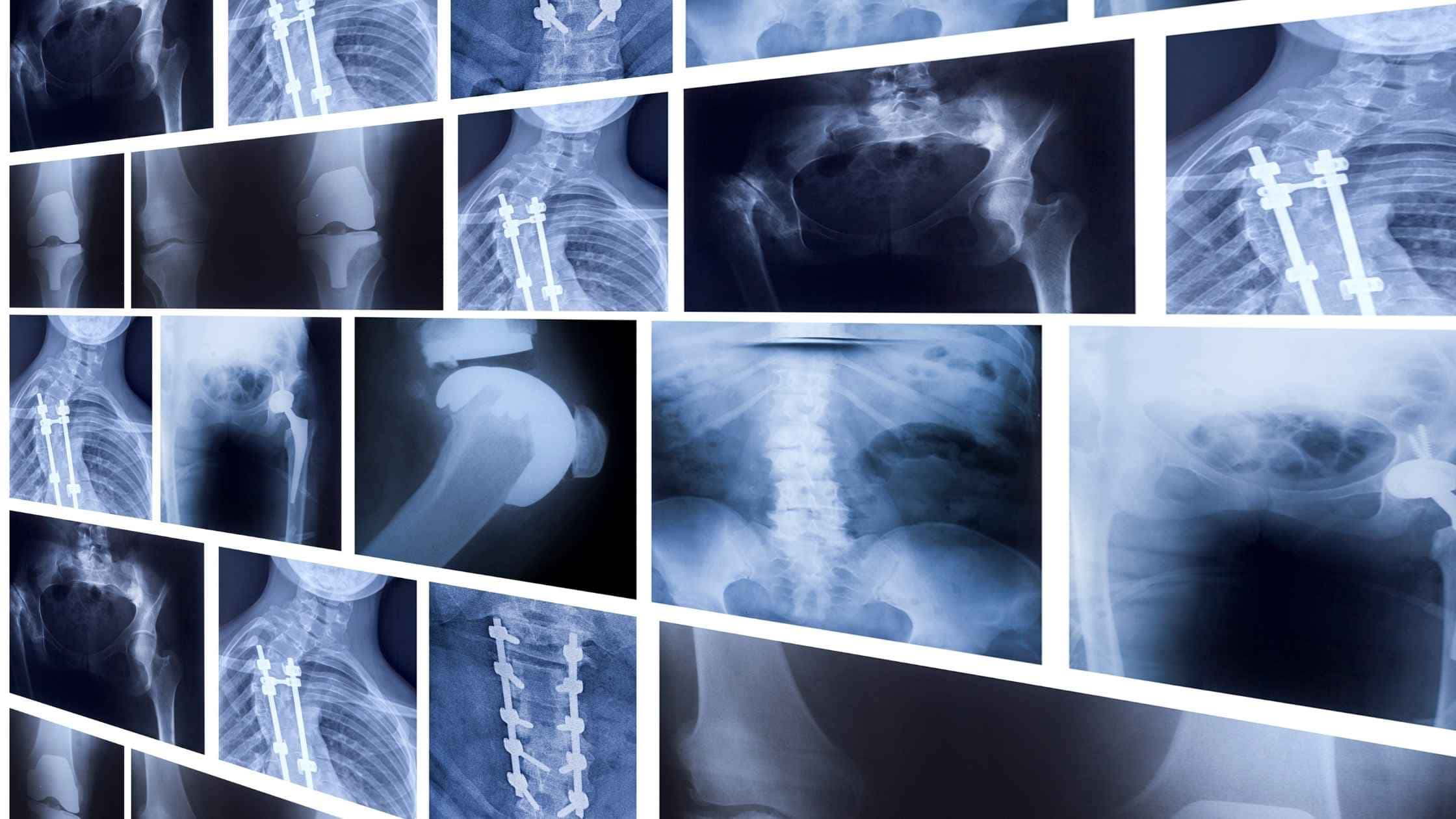 Fractures & Trauma