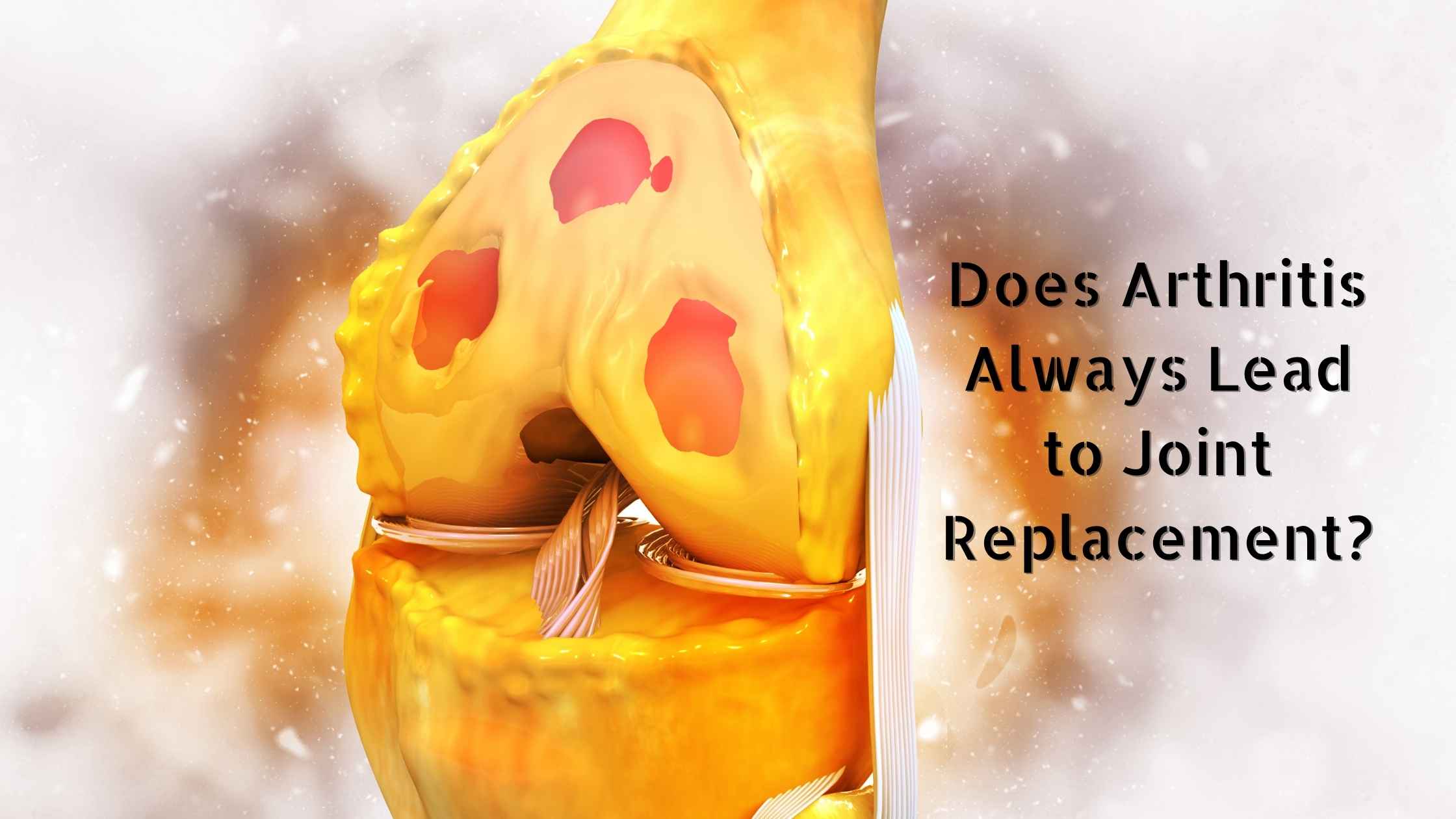 Does Arthritis Always Lead to Joint Replacement