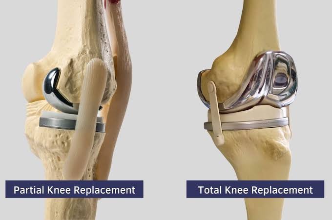 Total & Partial Joint Replacement